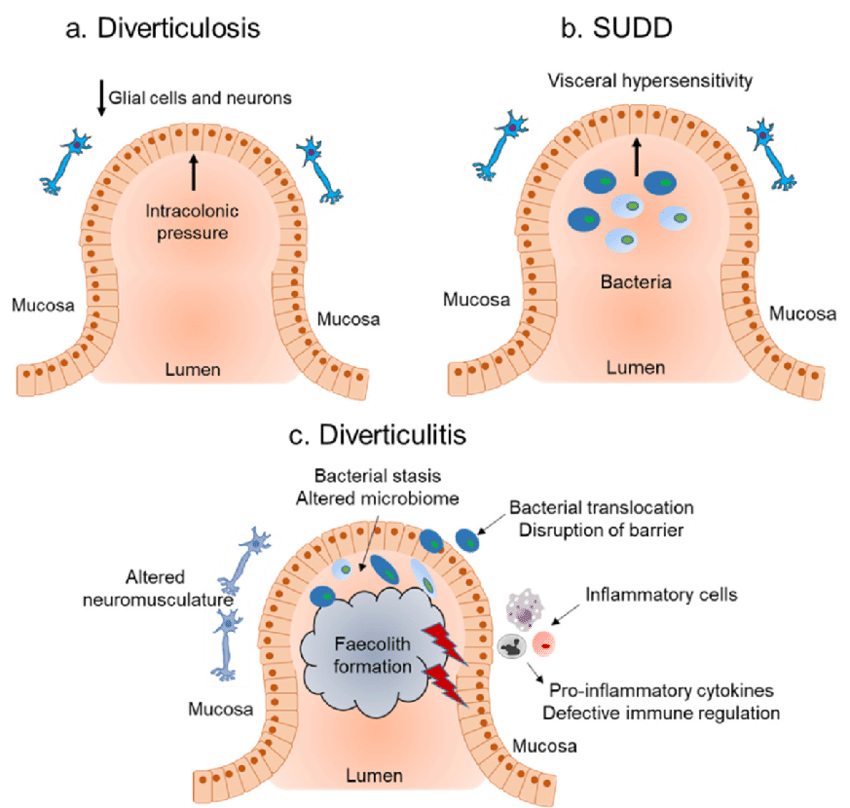 Diverticulosis, diverticular disease and diverticulitis EMbeds.co.uk